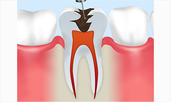 根管治療の流れ