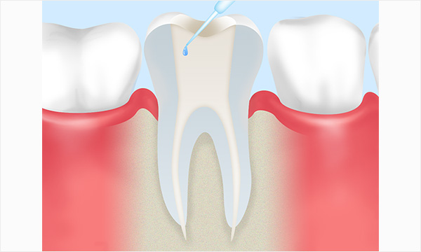 根管治療の流れ