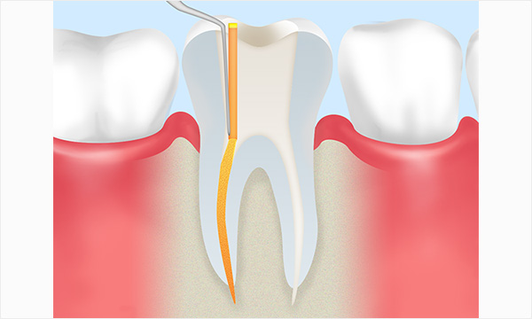 根管治療の流れ