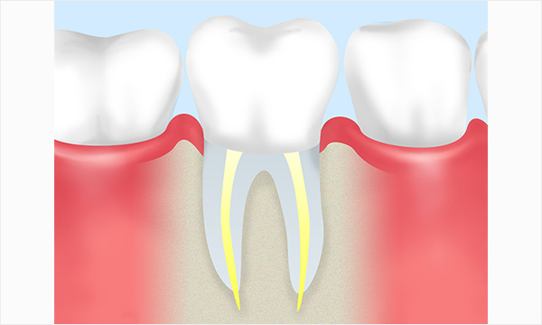 根管治療の流れ