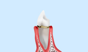 初期の歯周病（歯肉炎）