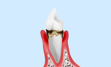 軽度～中等度の歯周病