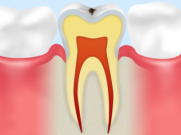初期むし歯（CO）